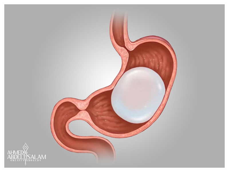 Gastric-Balloon