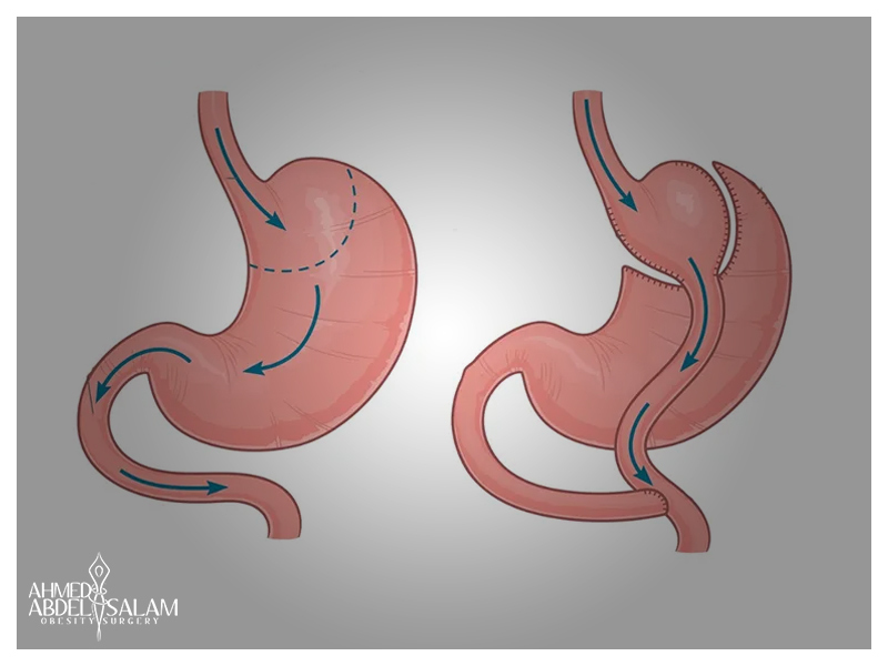 Gastric-Bypass Gastric-Bypass