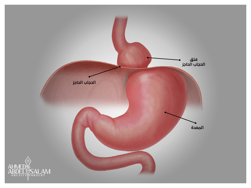 إصلاح-فتق-الحجاب-الحاجز-بالمنظار 