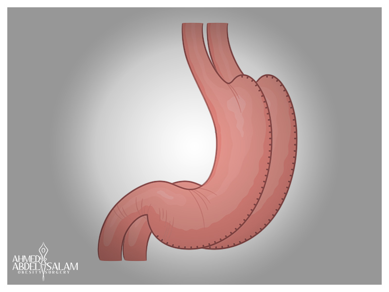 المعدة المتطابقة Identical Sleeve